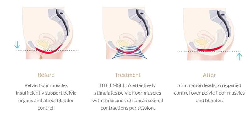 BTL Emsella illustration showing the before, during, and after effects of a treatment.