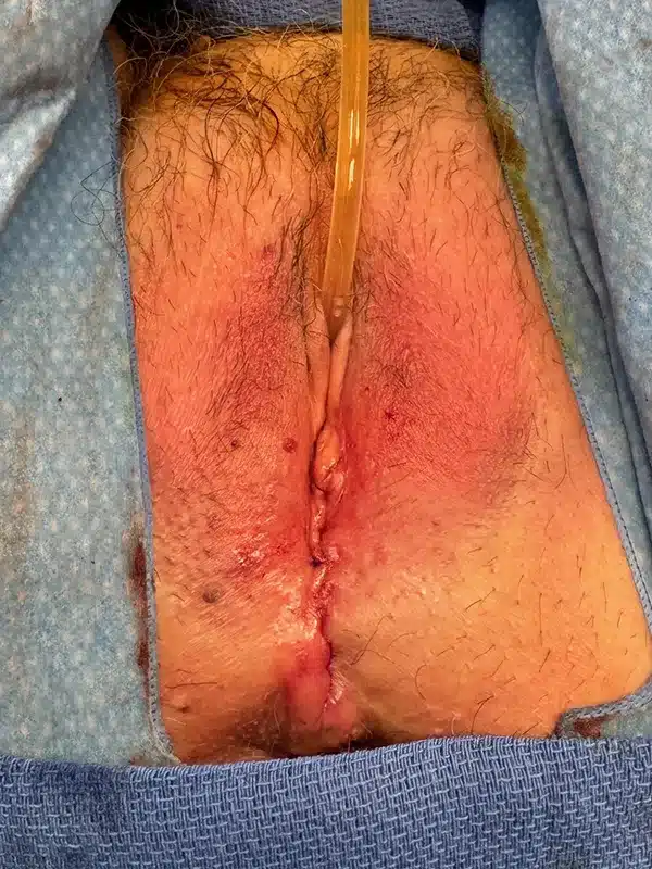 After complete colpocleisis Image #1